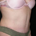 Tummy Tuck Before & After Patient #23057