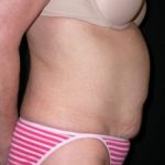 Tummy Tuck Before & After Patient #23057