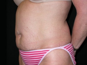 Tummy Tuck Before & After Patient #23057