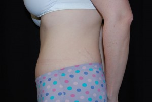 Tummy Tuck Before & After Patient #23068