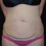 Tummy Tuck Before & After Patient #23068