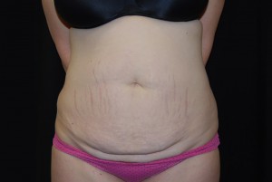 Tummy Tuck Before & After Patient #23068