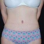 Tummy Tuck Before & After Patient #23068