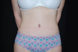 Tummy Tuck Before & After Patient #23068