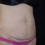 Tummy Tuck Before & After Patient #23068