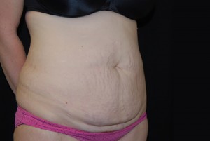 Tummy Tuck Before & After Patient #23068