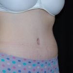 Tummy Tuck Before & After Patient #23068