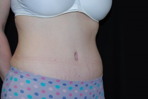 Tummy Tuck Before & After Patient #23068