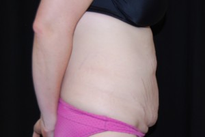 Tummy Tuck Before & After Patient #23068