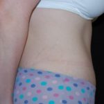 Tummy Tuck Before & After Patient #23068