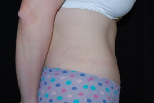 Tummy Tuck Before & After Patient #23068