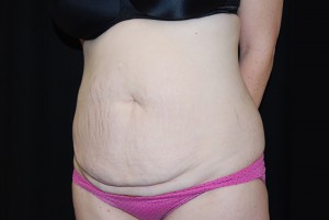 Tummy Tuck Before & After Patient #23068