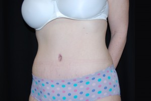 Tummy Tuck Before & After Patient #23068