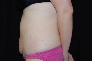 Tummy Tuck Before & After Patient #23068