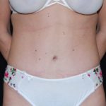 Tummy Tuck Before & After Patient #23092