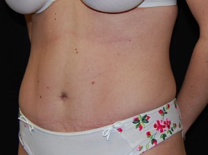Tummy Tuck Before & After Patient #23092