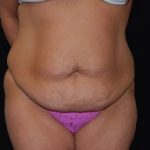 Tummy Tuck Before & After Patient #23123