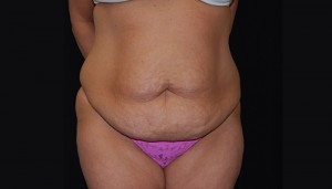 Tummy Tuck Before & After Patient #23123