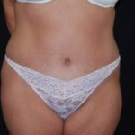 Tummy Tuck Before & After Patient #23123