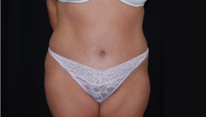 Tummy Tuck Before & After Patient #23123