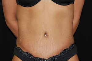 Tummy Tuck Before & After Patient #23135