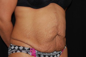 Tummy Tuck Before & After Patient #23135