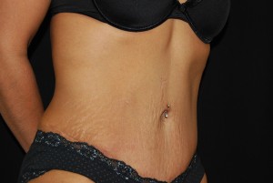 Tummy Tuck Before & After Patient #23135