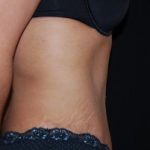 Tummy Tuck Before & After Patient #23135