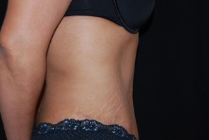 Tummy Tuck Before & After Patient #23135