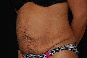 Tummy Tuck Before & After Patient #23135