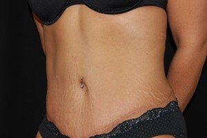Tummy Tuck Before & After Patient #23135