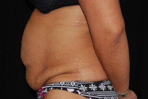 Tummy Tuck Before & After Patient #23135