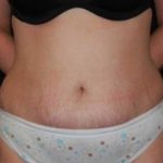 Tummy Tuck Before & After Patient #23154