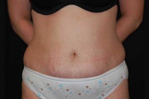 Tummy Tuck Before & After Patient #23154