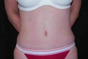 Tummy Tuck Before & After Patient #23154