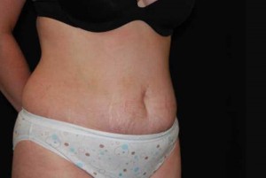 Tummy Tuck Before & After Patient #23154