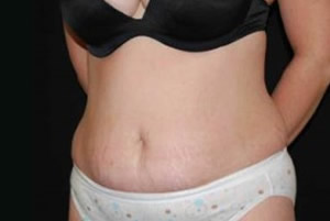 Tummy Tuck Before & After Patient #23154