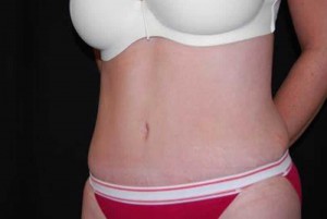 Tummy Tuck Before & After Patient #23154