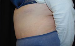 Tummy Tuck Before & After Patient #22415