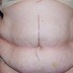 Tummy Tuck Before & After Patient #22415