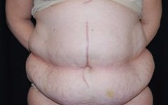 Tummy Tuck Before & After Patient #22415