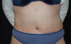 Tummy Tuck Before & After Patient #22415