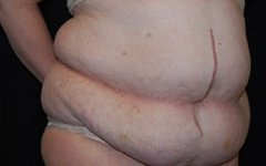 Tummy Tuck Before & After Patient #22415