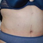 Tummy Tuck Before & After Patient #22415