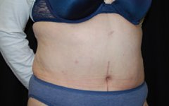 Tummy Tuck Before & After Patient #22415