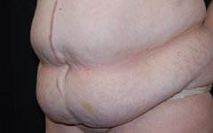 Tummy Tuck Before & After Patient #22415