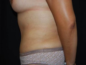 Tummy Tuck Before & After Patient #23166