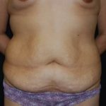 Tummy Tuck Before & After Patient #23166
