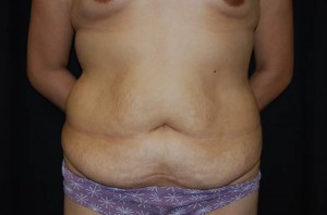 Tummy Tuck Before & After Patient #23166