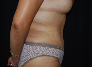 Tummy Tuck Before & After Patient #23166